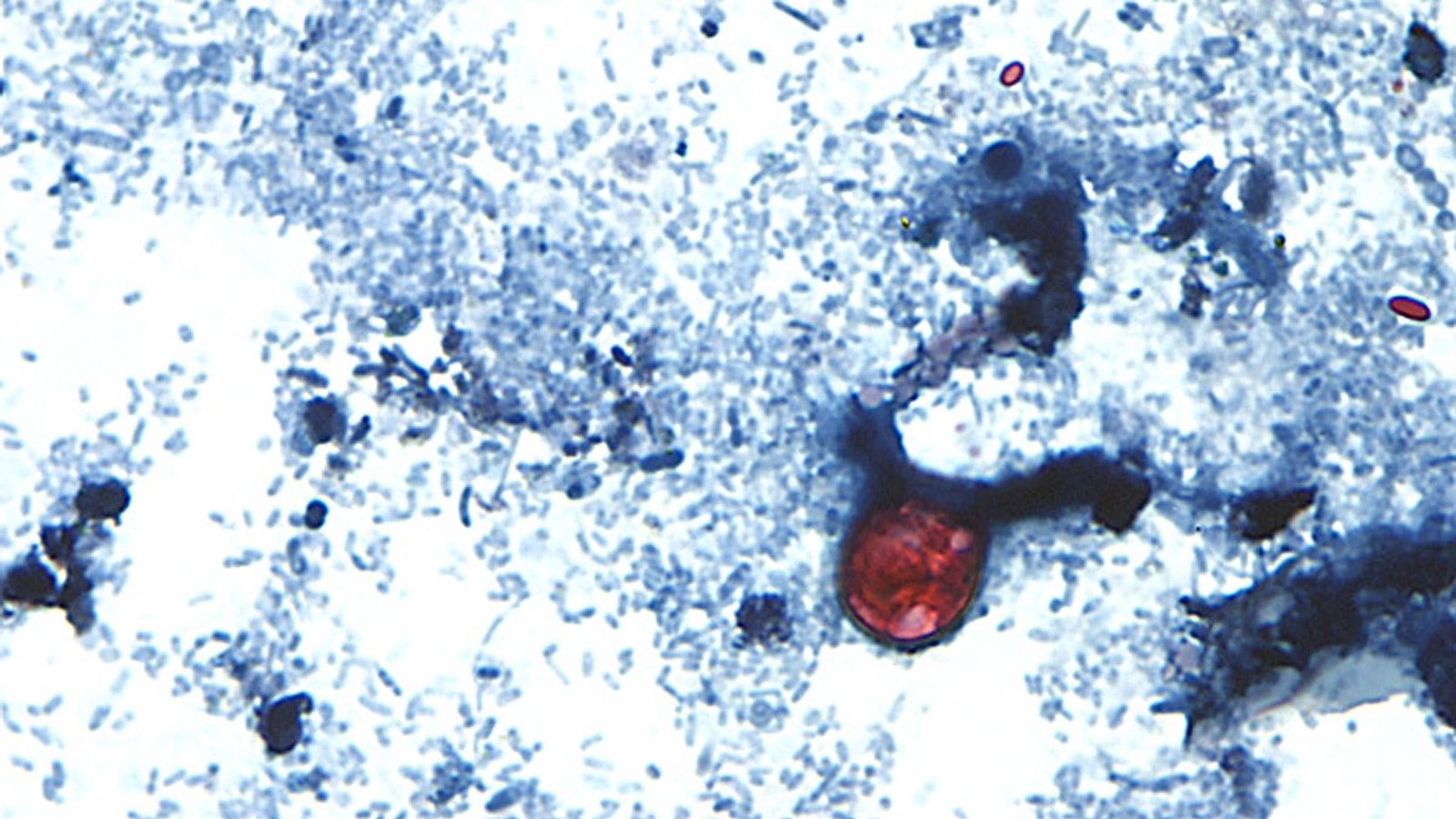 Two die as cases of ‘explosive diarrhoea’ infection surge in US state
